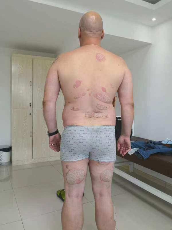 Лечение псориаза - до