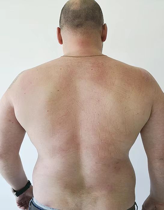 Лечение псориаза - после