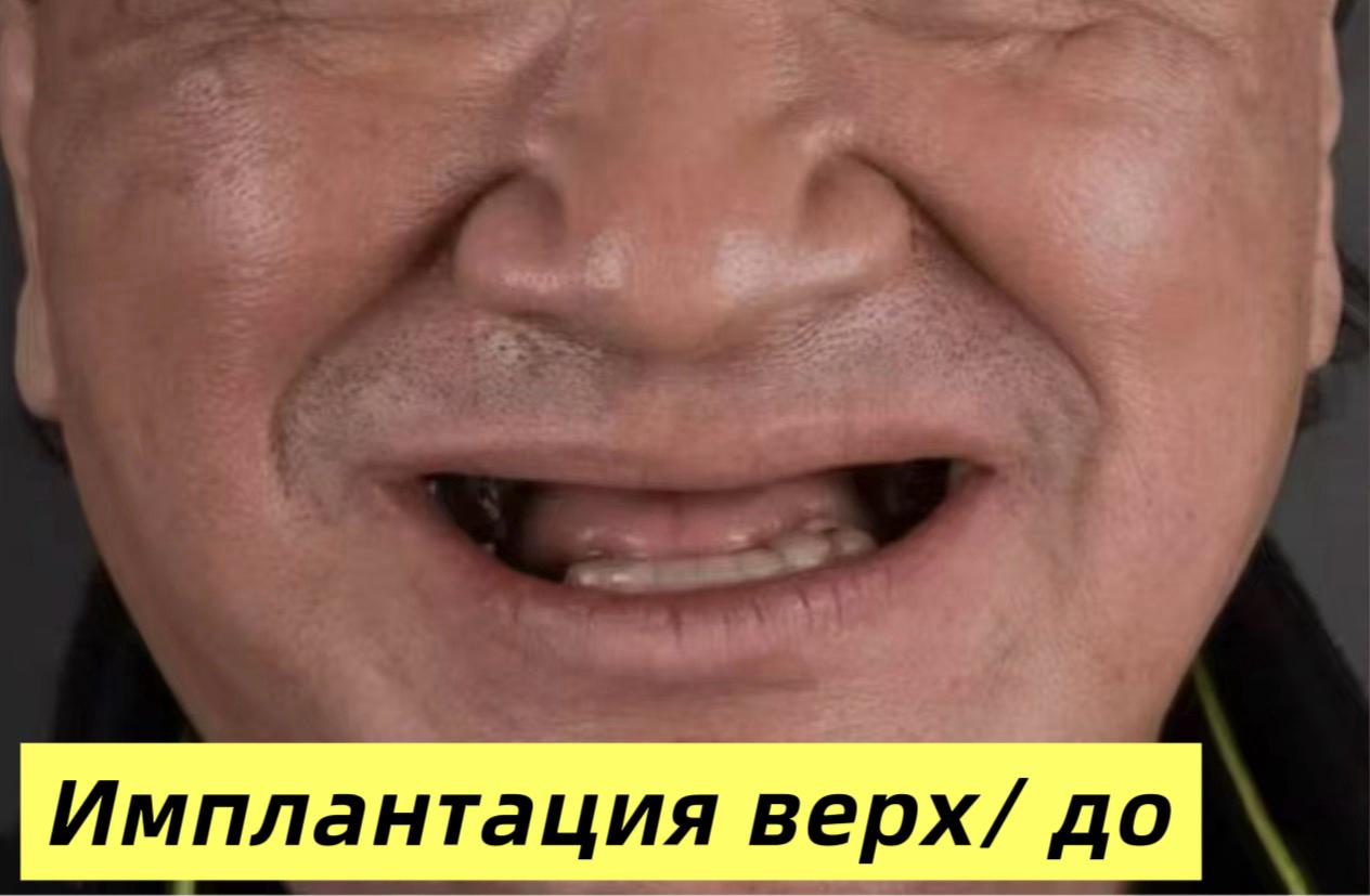 Имплантация верхних зубов (до/после) - после