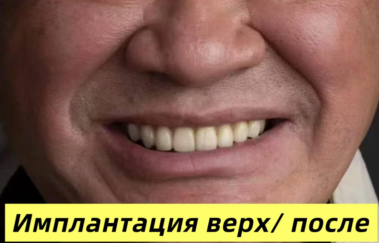 Имплантация верхних зубов (до/после) - до