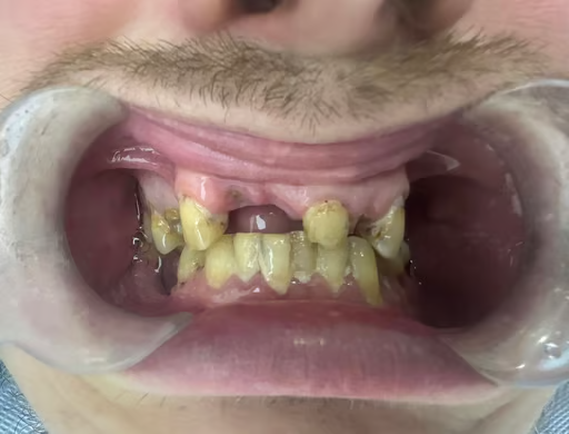 Новая улыбка — новая жизнь (коронки) - до