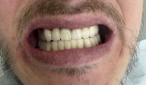 Новая улыбка — новая жизнь (коронки) - после